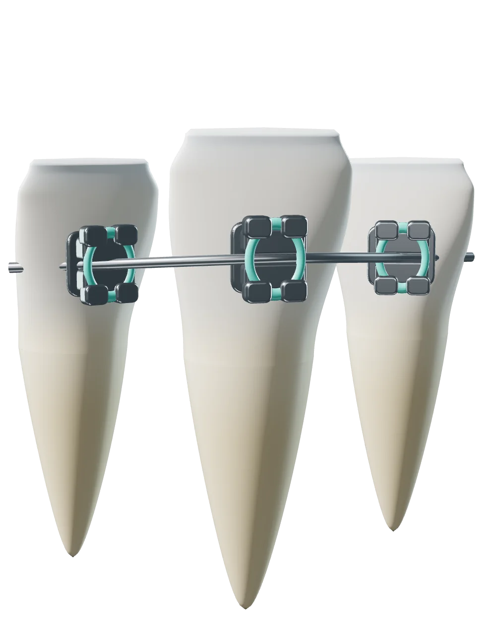 Incisivos com brackets e arco ortodôntico